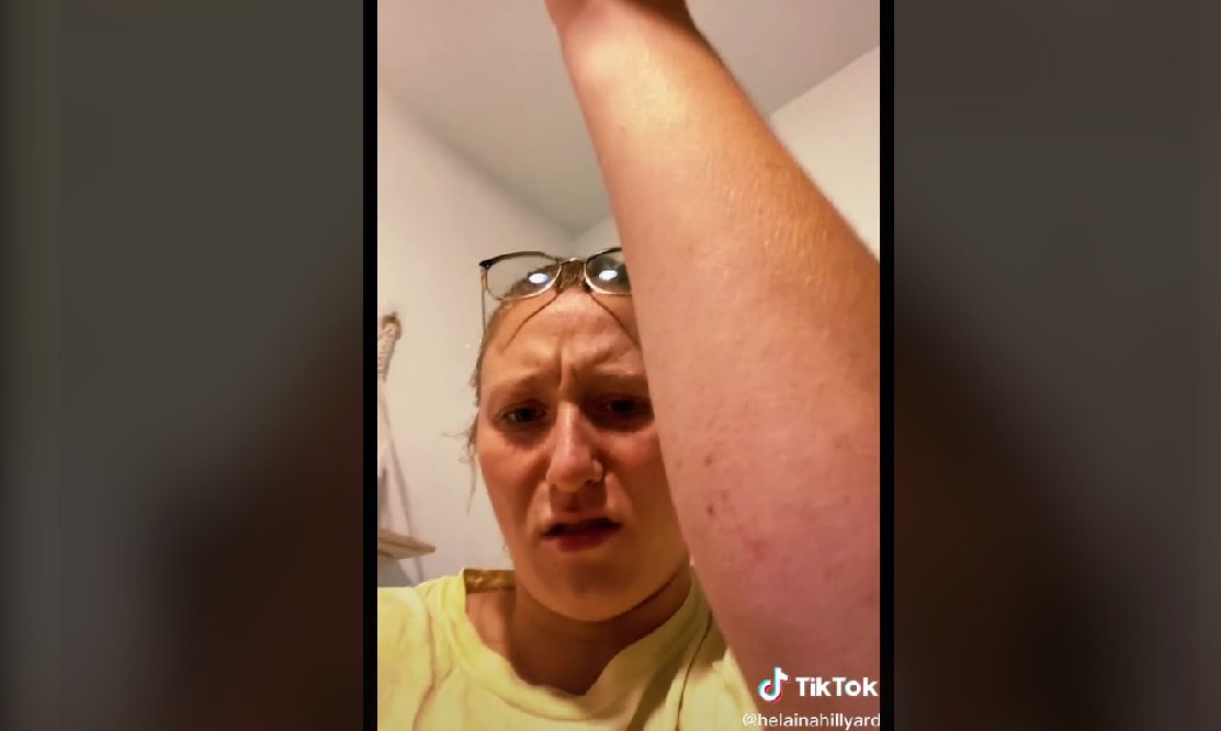 VIDEO Amerikanka doznala da ima rak nakon što su joj se po tijelu počele širiti crvene točkice