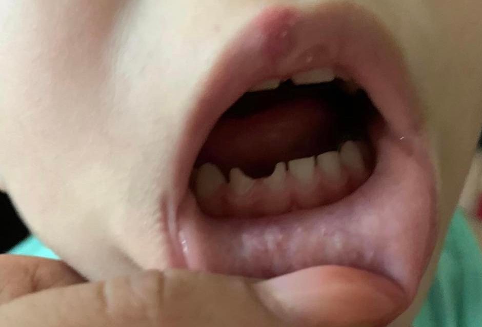 Šok u Sarajevu: Tete u vrtiću toliko natukle dijete da su mu slomile zube