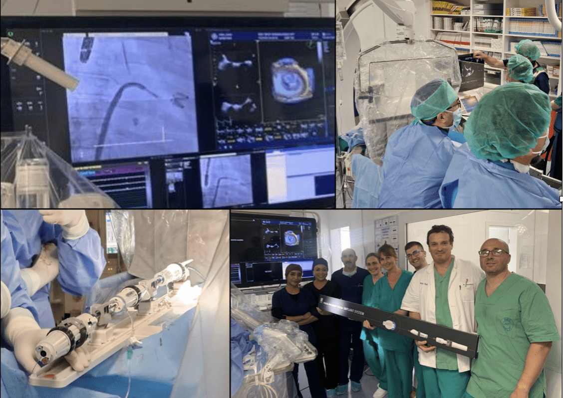 KBC SPLIT SE SVRSTAVA U SAM VRH MEDICINSKE IZVRSNOSTI Prve procedure transkateterskog popravka mitralnog zalistka korištenjem novog sustava PASCAL u KBC-u Split